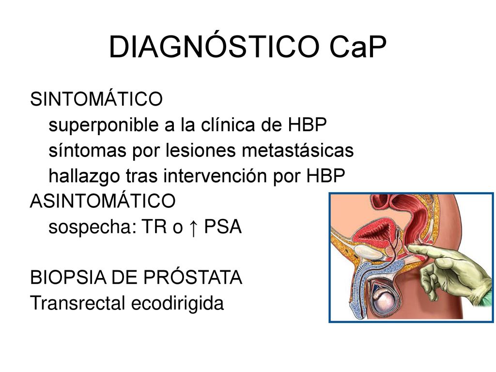 biopsia de prostata transrectal ecodirigida biopsia de prostata transrectal ecodirigida